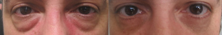 blefero inferiore2 - Blefaroplastica inferiore: intervento laser su borse sotto gli occhi