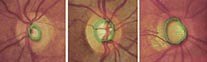 galucoma - STL - l’alternativa delicata per la terapia del glaucoma