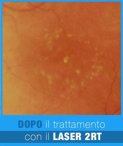 AMD Dopo il trattamento